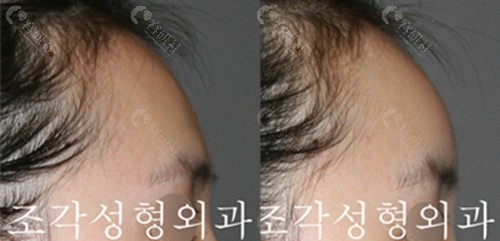 韩国雕刻整形外科额头骨水泥填充术后效果