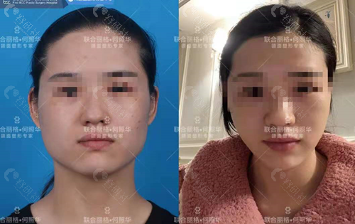 北京联合丽格医疗美容医院下颌角磨骨对比照