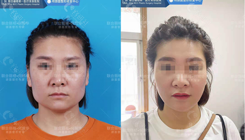 北京联合丽格医疗美容医院下颌角磨骨对比照