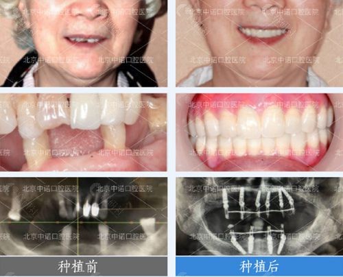 北京中诺口腔种植牙对比照