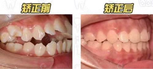 长沙美奥口腔医院牙齿矫正对比照