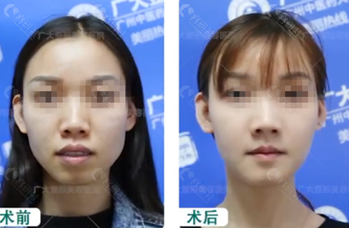 在广州广大做下颌角后脸型改变明显