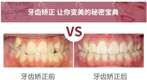 上海雅悦齿科牙齿矫正对比照