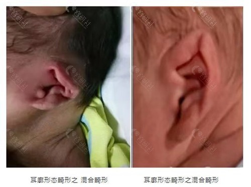 耳廓畸形的不同种类图解