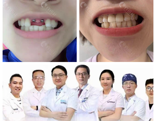 衡阳优牙仕口腔医院种植牙对比照