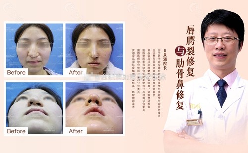 合肥壹加壹整形美容医院唇腭裂和肋骨鼻修复术前术后对比效果图