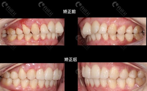 杭州雅莱口腔牙齿矫正前后对比照