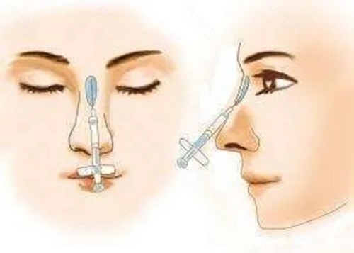 玻尿酸注射隆鼻科普图