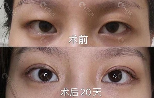 郑州天后医疗美容医院双眼皮对比照