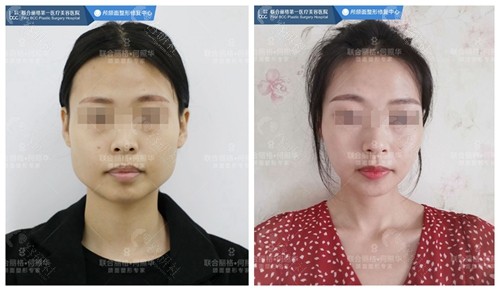 北京联合丽格何照华下颌角手术前后对比照片