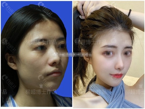 广州韩妃柳超下颌角手术前后对比照片