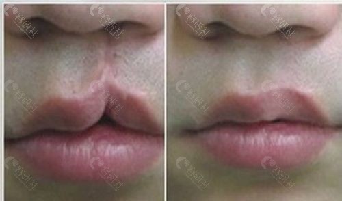 唇腭裂修复前后对比图片