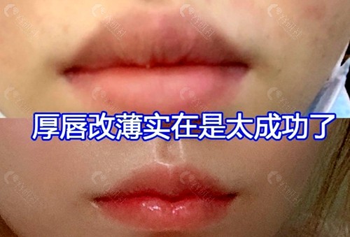 北京画美医疗美容医院厚唇改薄术前术后对比效果图