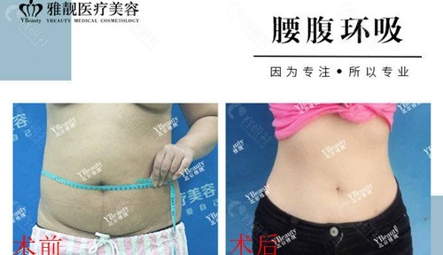 北京雅靓医疗美容腰腹吸脂前后对比图