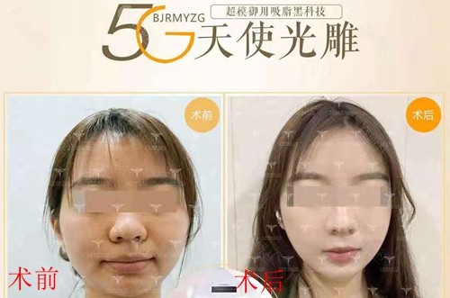 北京润美玉之光医疗美容5G天使光雕面部吸脂前后对比照
