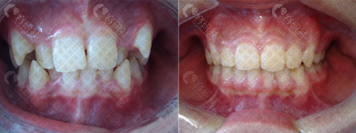 淮南安美口腔牙齿矫正对比照