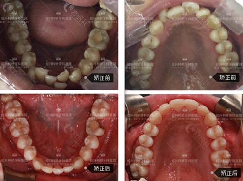 绍兴柯桥牙科牙齿矫正前后对比照