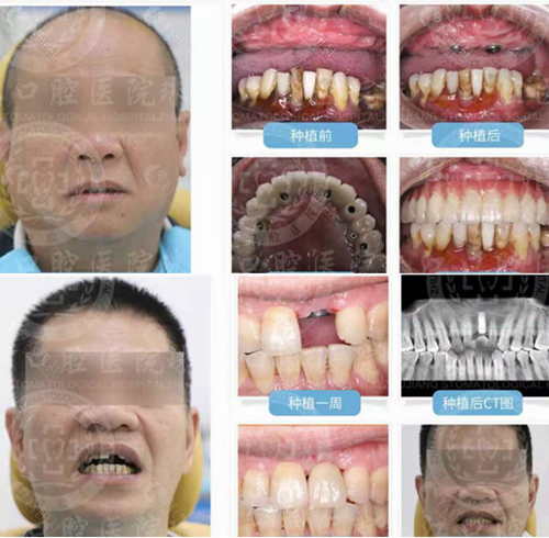 湛江市珠江口腔医院种植牙对比照