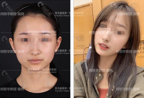 北京联合丽格下颌角手术对比照