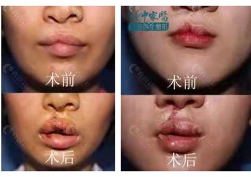广州中家医家庭医生唇腭裂修复前后对比照片