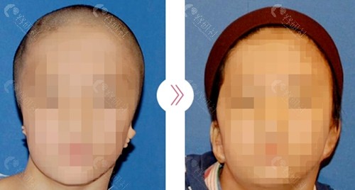 小耳畸形大小脸好治疗吗?耳再造手术前后对比图