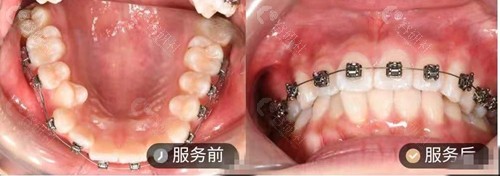 惠州惠城瑞福臣口腔牙齿矫正效果照片