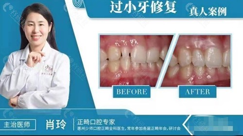 惠州少师百年口腔牙齿修复对比照