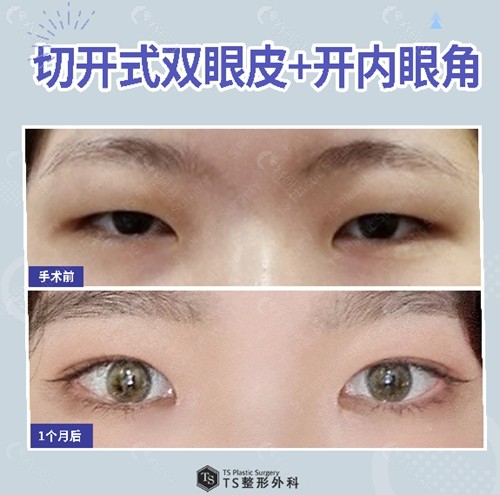 韩国有名的眼修复医院TS整形外科眼综合+开眼角图片