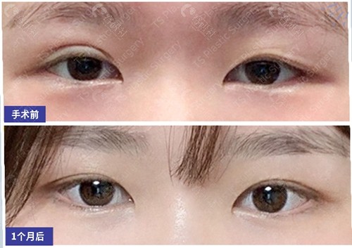 韩国有名的眼修复医院TS整形外科肉条眼修复效果图