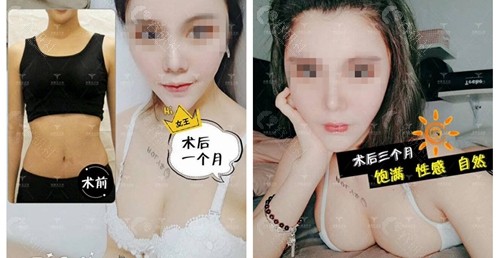北京润美玉之光医疗美容王明利医生自体脂肪隆胸术前术后对比图