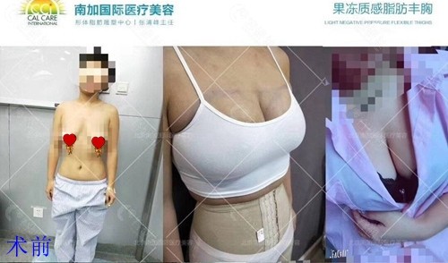 北京南加国 际医疗美容张清峰医生果冻质感脂肪丰胸对比图