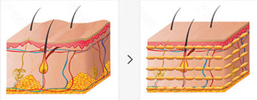 脂肪填充前后变化