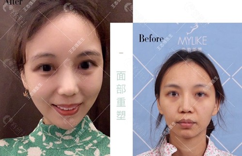 北京美莱医疗美容医院王志强医生面部自体脂肪填充术前术后对比图
