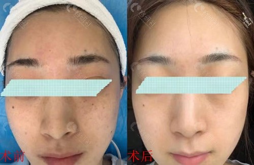 武汉医疗美容医院超皮秒面部祛斑前后对比照