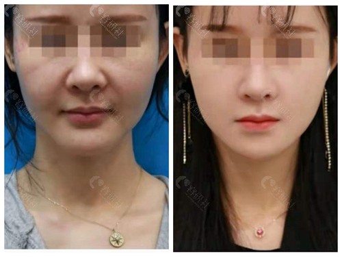 北京加减美做面部拉皮术后效果