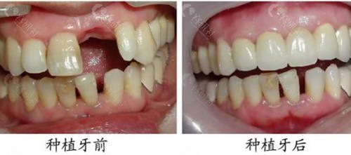 北京劲松口腔医院种植牙前后对比图