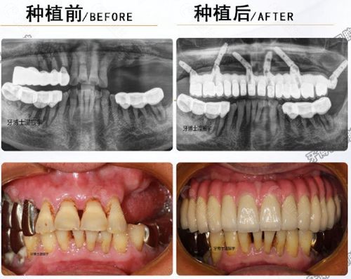 泉州牙博士口腔种植牙对比照