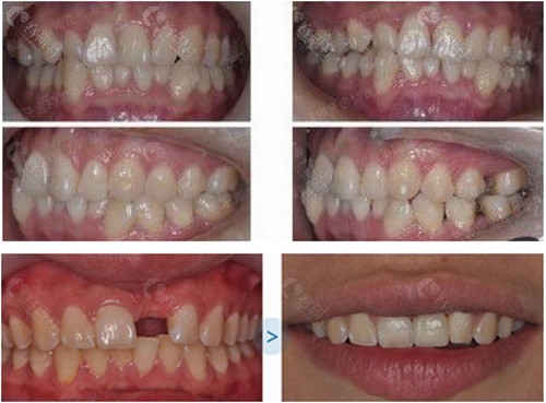 福州维乐口腔牙齿矫正和单颗牙种植前后对比照片