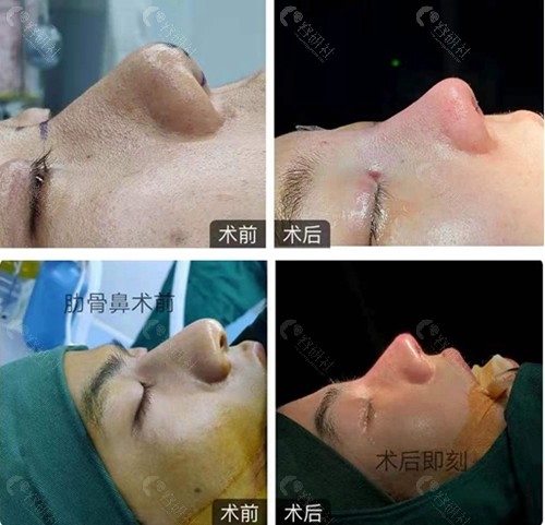 宁波海曙整形外科医院隆鼻前后对比效果图