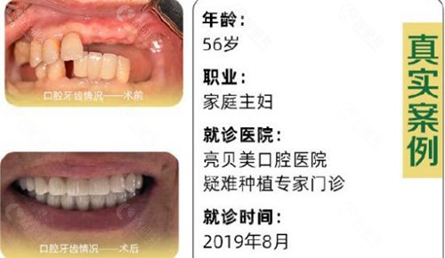 杭州亮贝美口腔种植牙术前术后对比