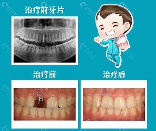 深圳格伦菲尔单颗种植牙前后对比照