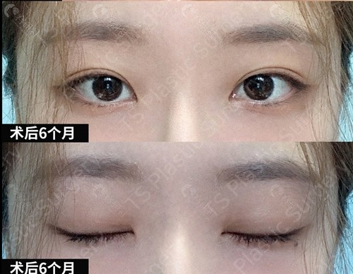 韩国TS埋线双眼皮+提肌矫正术后6个月睁眼闭眼效果图