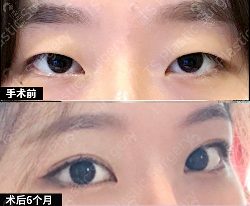 韩国TS埋线双眼皮+提肌矫正手术前和术后6个月对比图