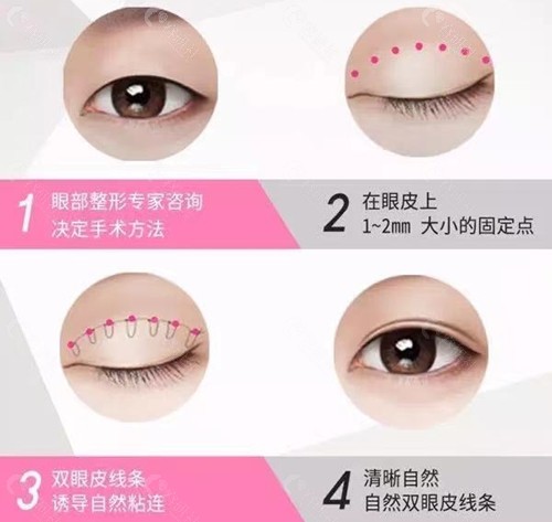 为什么韩国流行自然粘连双眼皮手术呢？自然粘连双眼皮的手术方法和优势