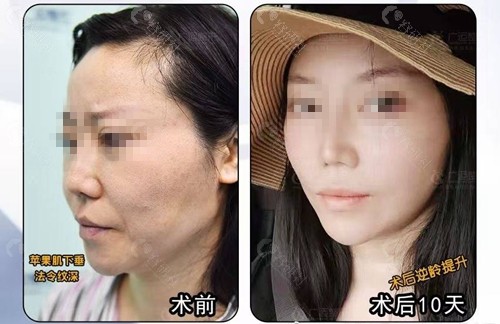郑州广运医疗美容整形面部拉皮提升术前术后对比效果图