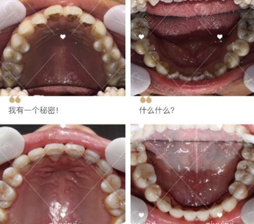 西安交大口腔医院牙齿矫正前后对比照