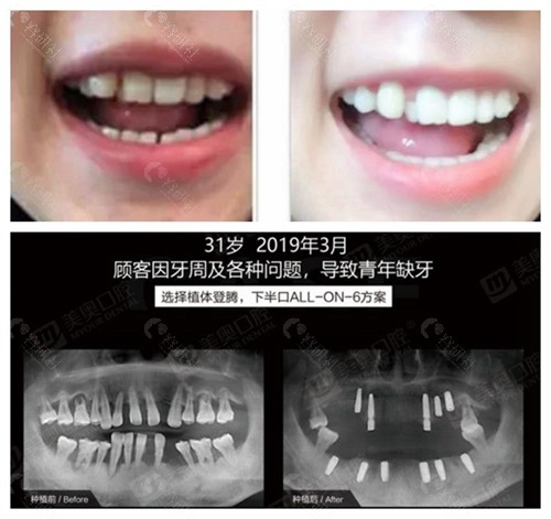 长沙美奥口腔医院牙齿矫正和种植牙前后对比照片