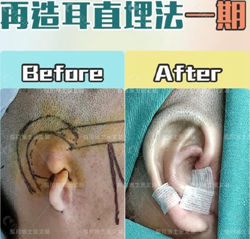 广州高尚医疗美容中心余文林耳再造术前术后对比