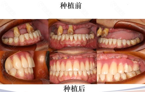 成都锦江极光口腔种植牙术前术后对比