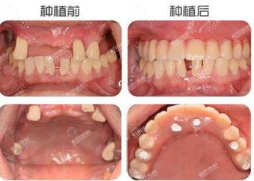 成都科瓦齿科种植牙前后对比照